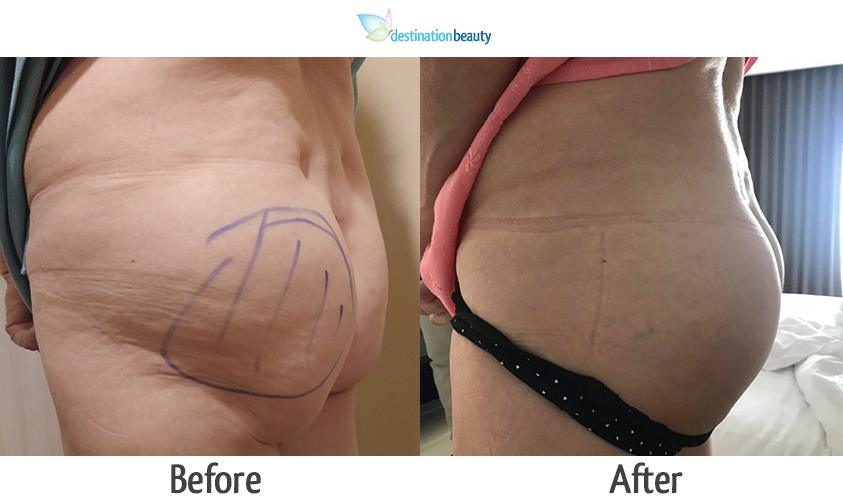 before and after buttock implant thailand