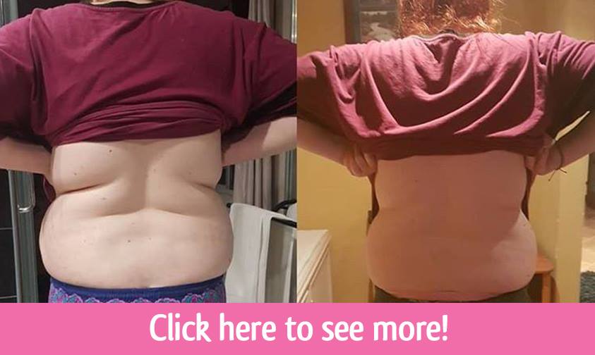 before and after gastric sleeve-1