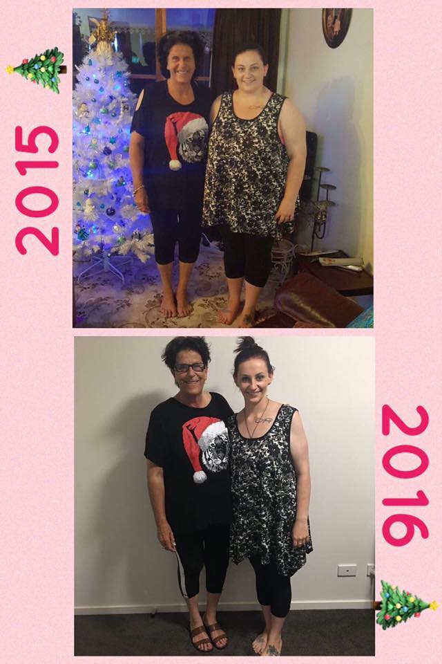 before and after gastric sleeve