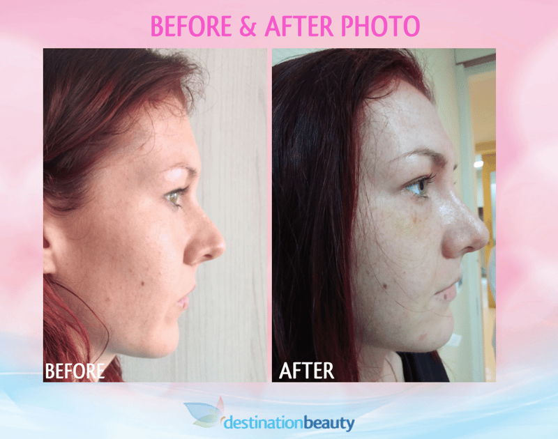 before and after nose reshaping