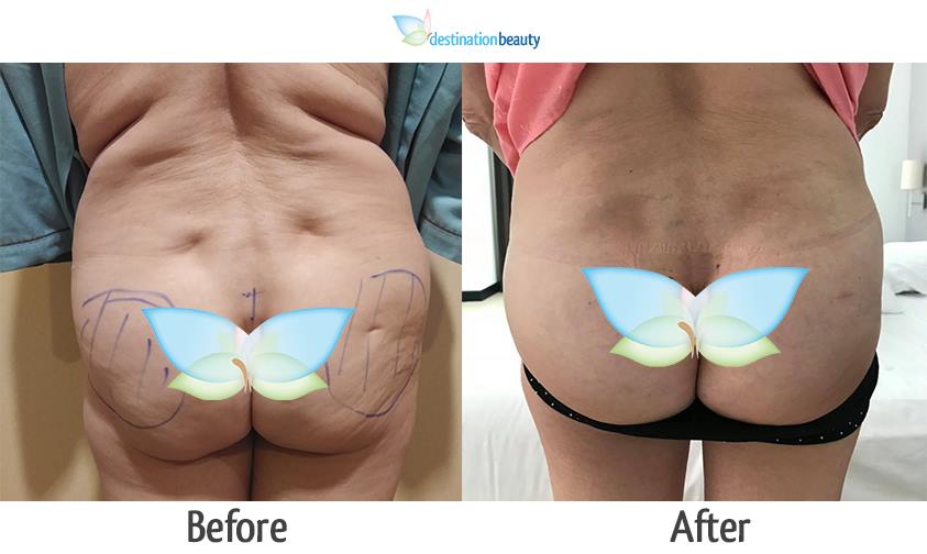 before and after pictures of buttock implant thailand