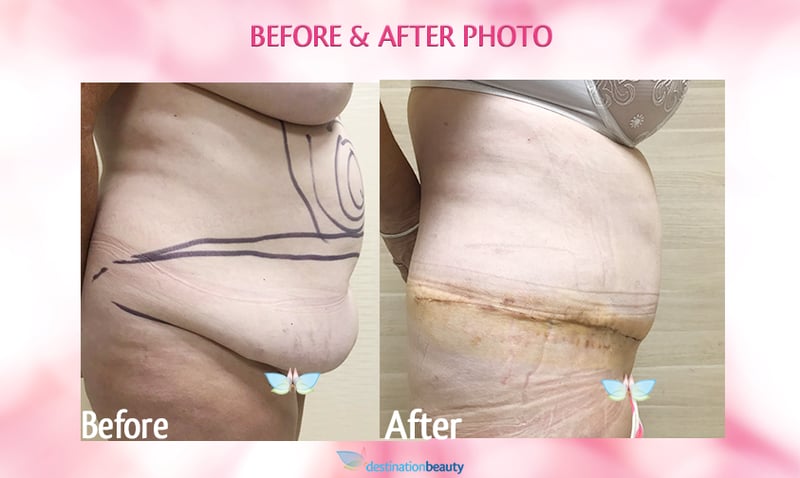 before and after tummy tuck and liposuction bangkok