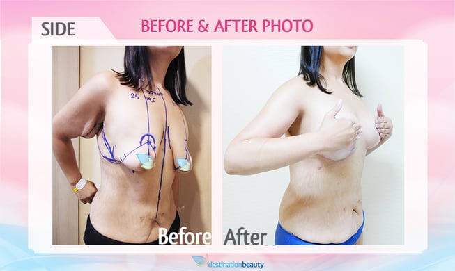 before-and-after-breast-augementation-with-lift-.png