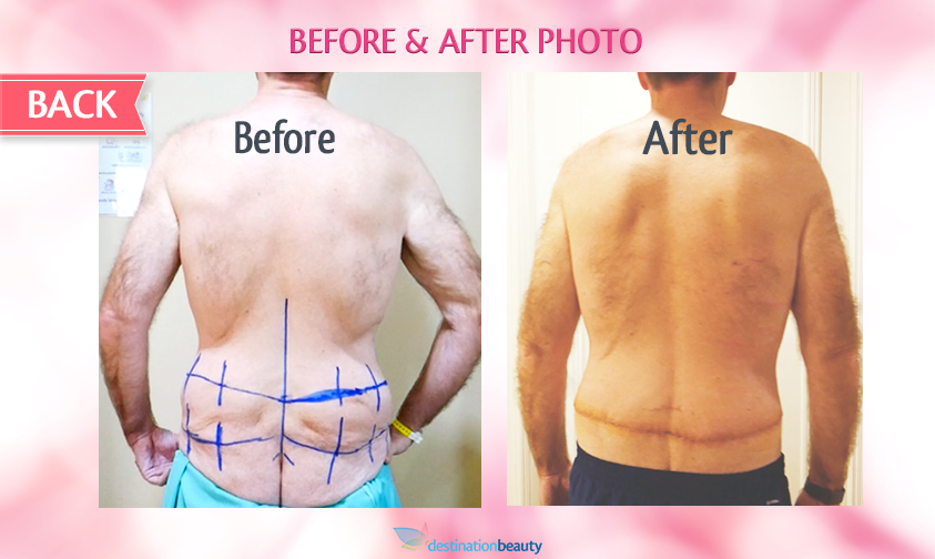belt lipectomy bangkok-before and after-back view