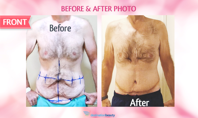 belt lipectomy bangkok-before and after-front view