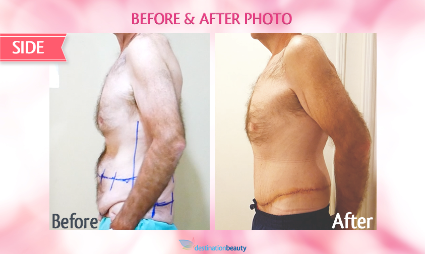 belt lipectomy bangkok-before and after-side view-left