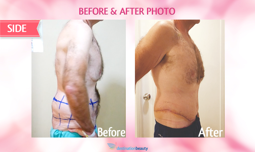 belt lipectomy bangkok-before and after-side view-right