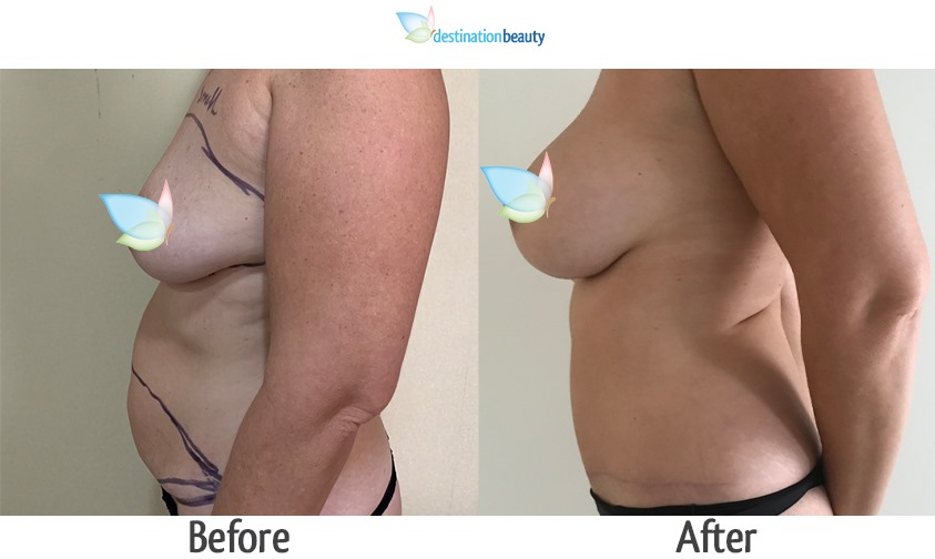 breast augmentation and tummy tuck 2