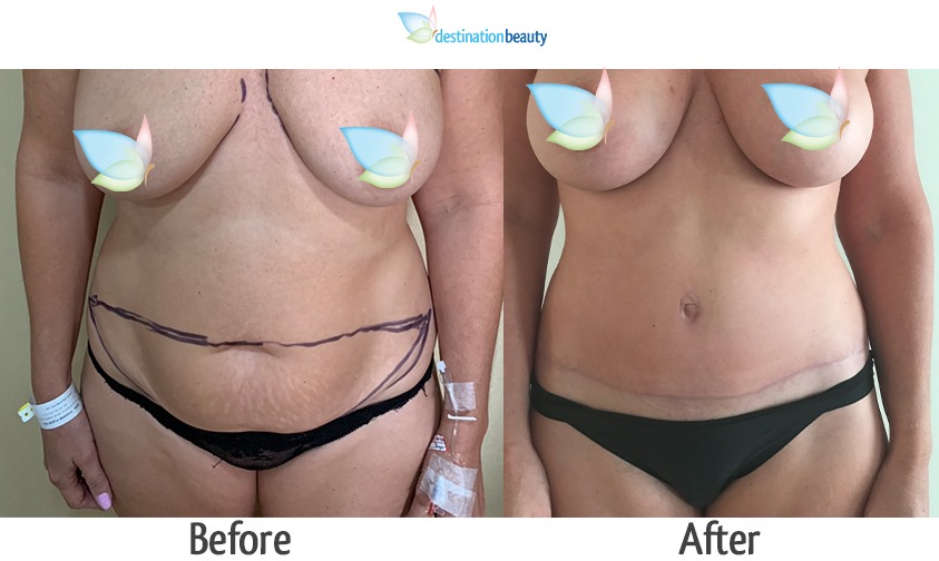 breast augmentation and tummy tuck