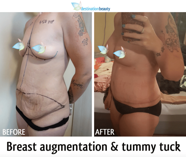 breast augmentation and tummy tuck