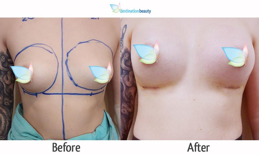 breast augmentation thailand