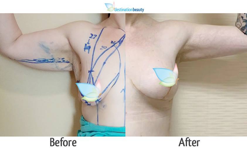breast augmentation with lift and arm lift thailand before and after