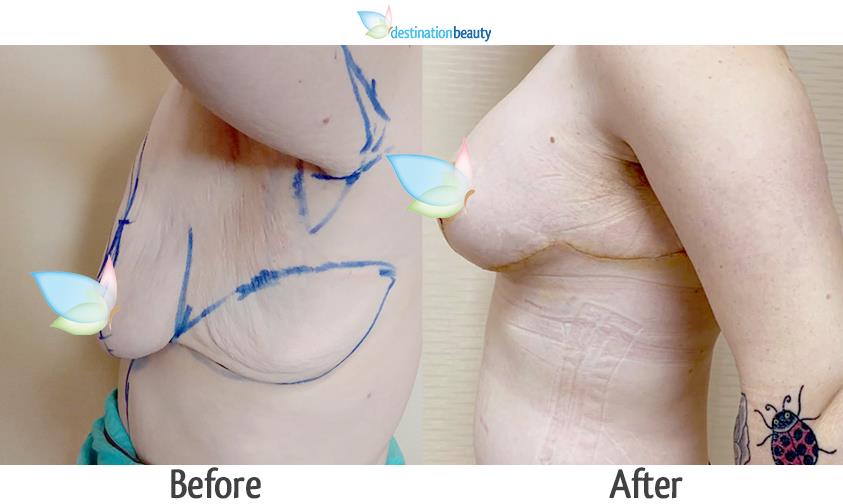 breast augmentation with lift and arm lift thailand