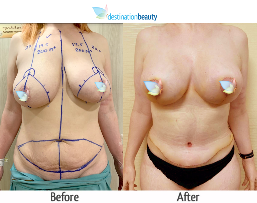 breast augmentation with lift and extended tummy tuck (2)