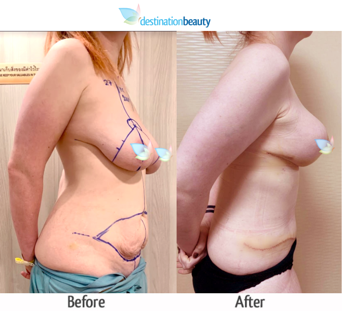 breast augmentation with lift and extended tummy tuck (3)