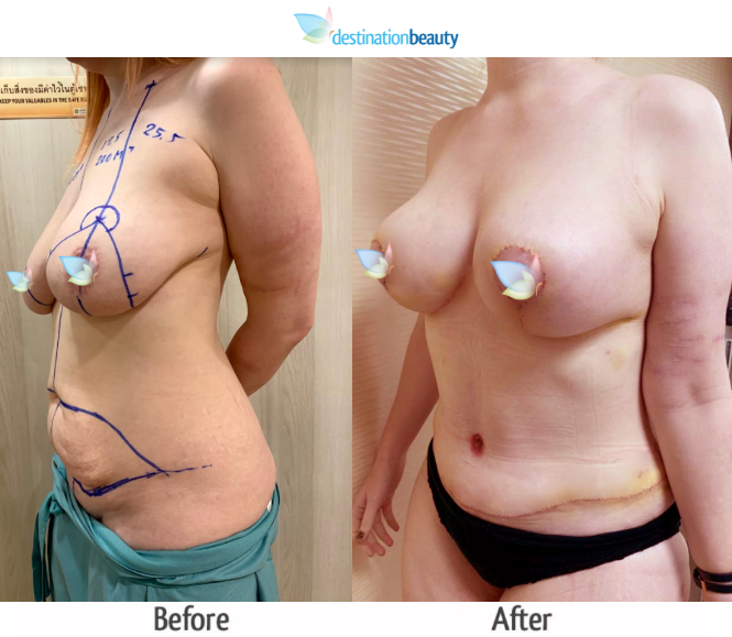 breast augmentation with lift and extended tummy tuck (4)