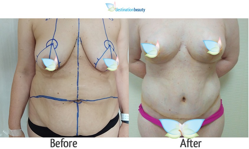 breast augmentation with lift and extended tummy tuck 2