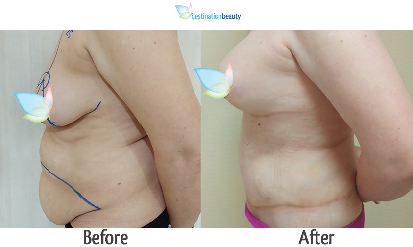 breast augmentation with lift and extended tummy tuck-1