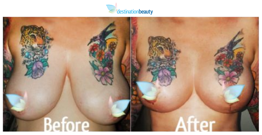 breast augmentation with lift and tummy tuck thailand 2