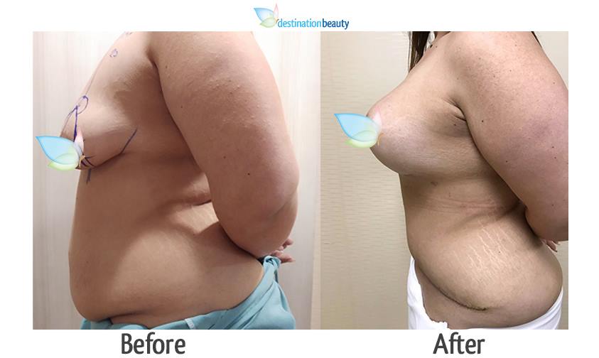 breast augmentation with lift and tummy tuck thailand before and after pictures