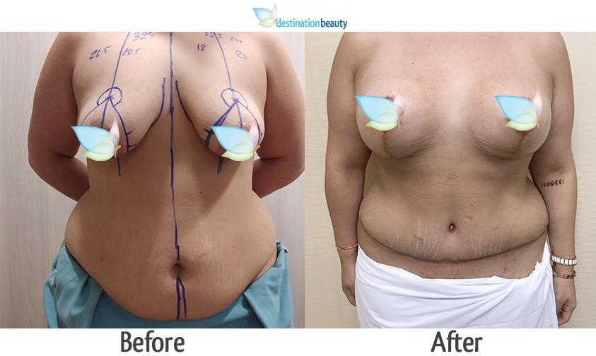 breast augmentation with lift and tummy tuck thailand