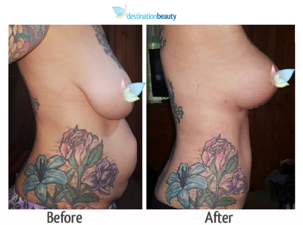 breast augmentation with lift and tummy tuck thailand
