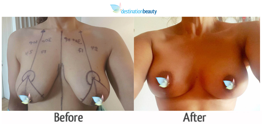 breast augmentation with lift before and after 7