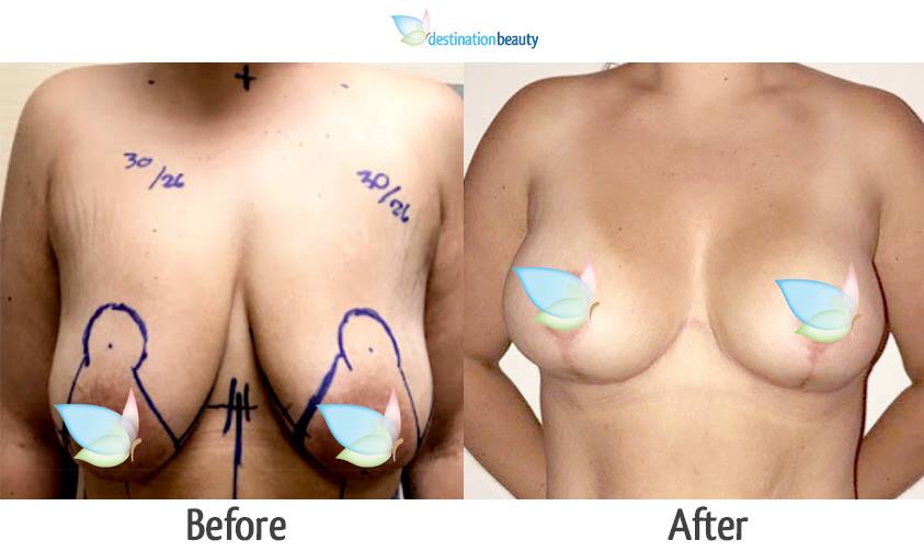 breast augmentation with lift in Thailand