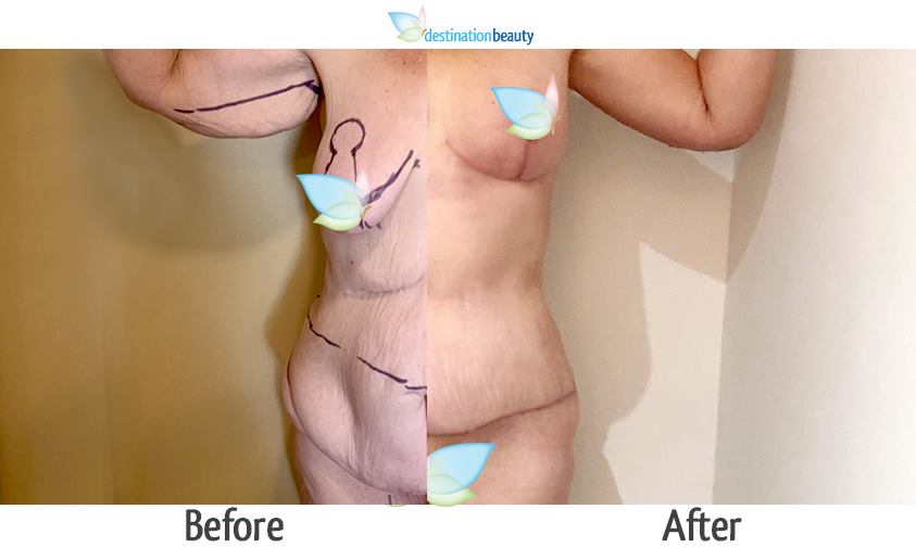 breast augmentation with lift, extended tummy tuck, arm lift, mons lift