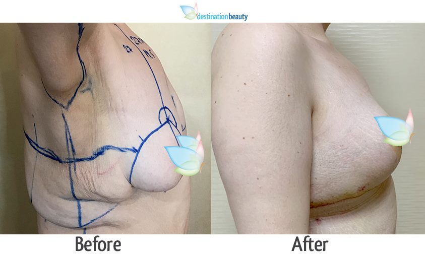 breast augmentation with lift, side lift thailand