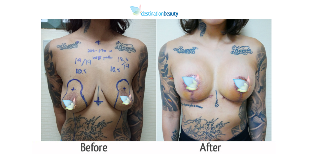 breast augmentation with lift_dr_kasemsak 3