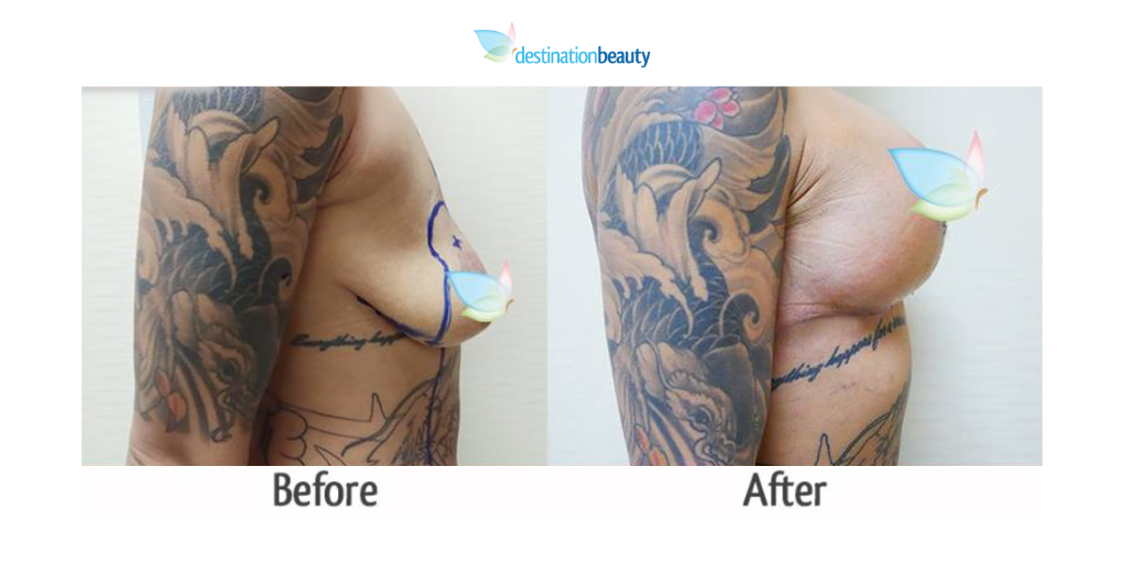 breast augmentation with lift_dr_kasemsak 4