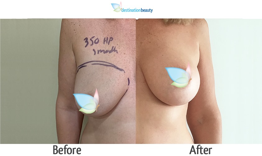 breast augmentation