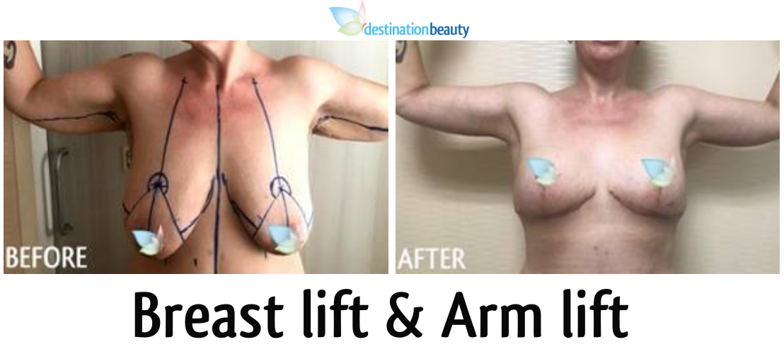 breast lift and arm lift thailand