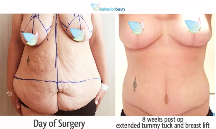 breast lift and extended tummy tuck
