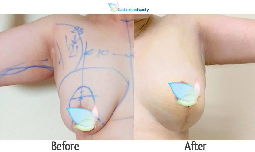 breast lift before and after pictures in Thailand (2)