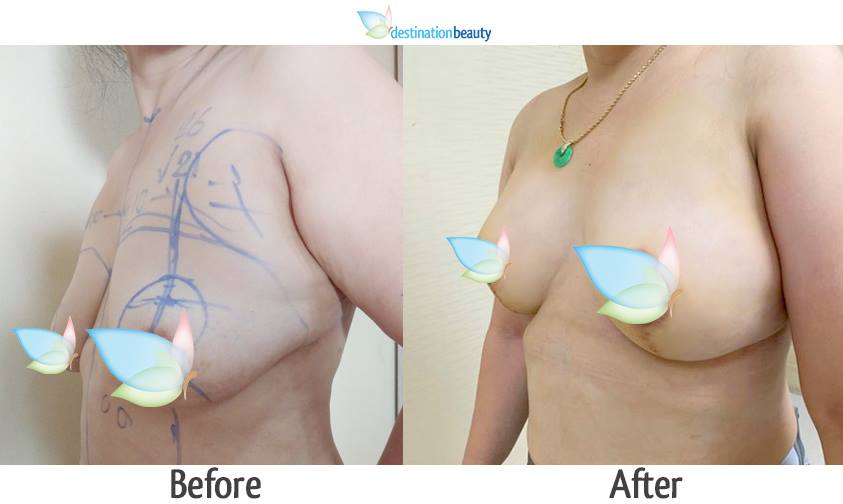 breast lift before and after pictures in Thailand