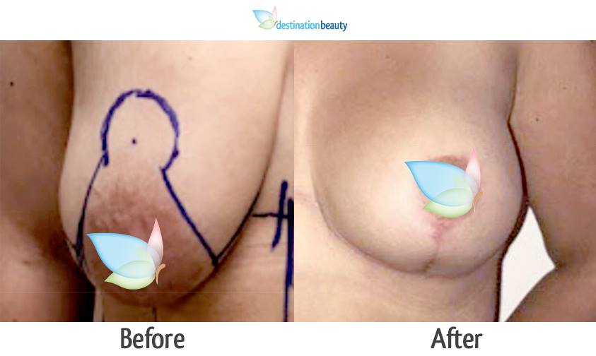 breast lift with implants thailand