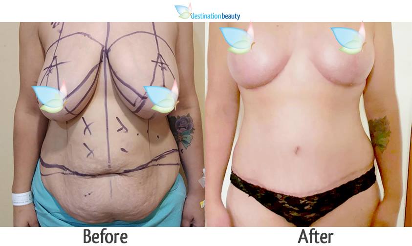 breast reduction and extended tummy tuck 1