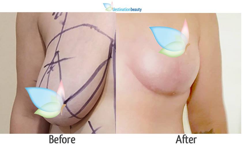 breast reduction and extended tummy tuck 2