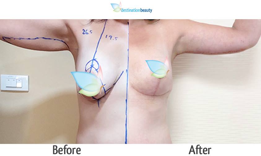 breast reduction arm lift-1