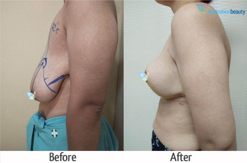 breast reduction before and after pictures