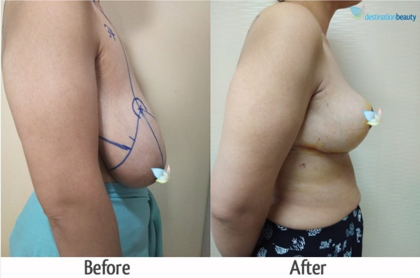 breast reduction before and after thailand