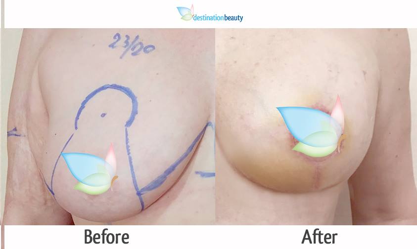 breast reduction with implants (2)