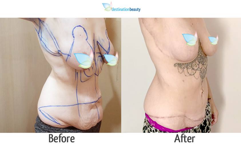 breast reduction with implants, extended tummy tuck, arm lift 2-1