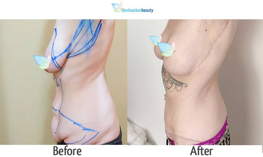 breast reduction with implants, extended tummy tuck, arm lift 3