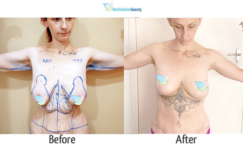 breast reduction with implants, extended tummy tuck, arm lift