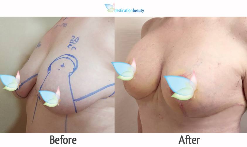 breast reduction with implants