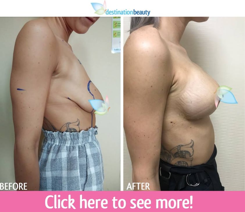 breast reduction with small implants thailand