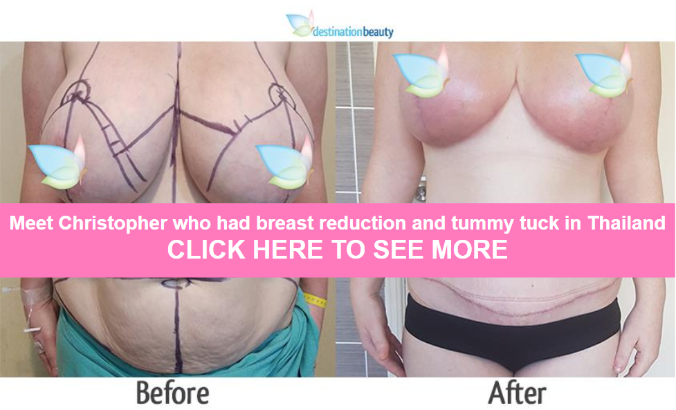 christohper breast reduction and tummy tuck